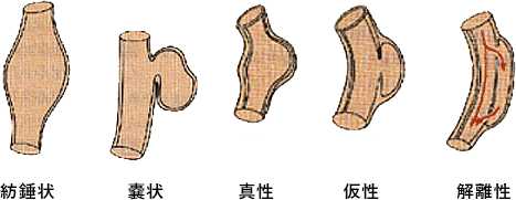 大動脈瘤手術